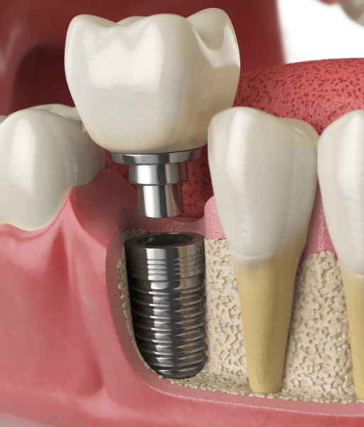 Implant